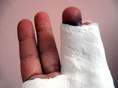 broken fingers in cast