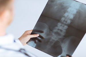 Doctor holding a spinal cord x-ray