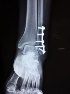 Ankle Injury and Reconstruction X-Ray for personal injury claim